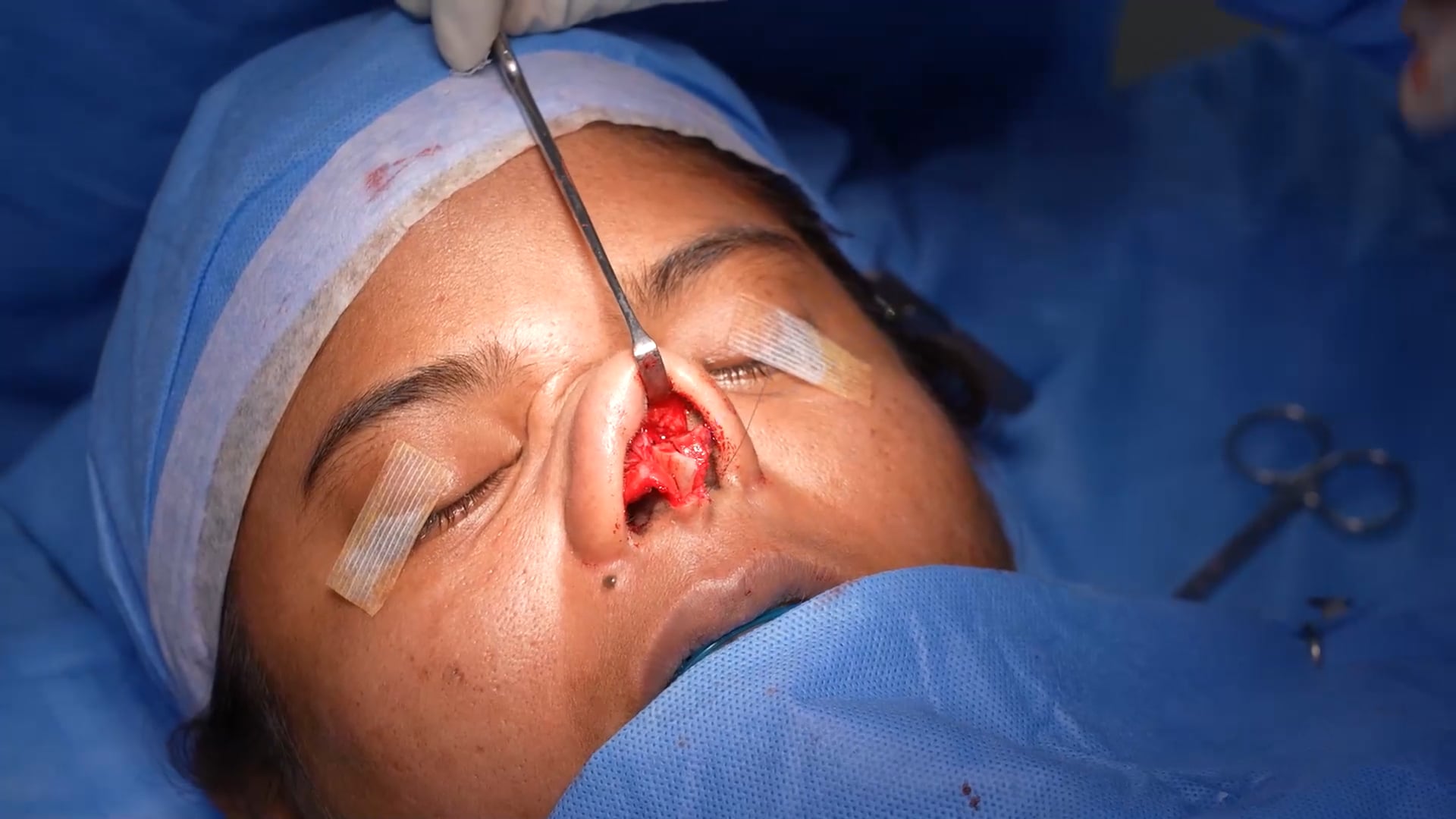 Rhinoplasty Surgery